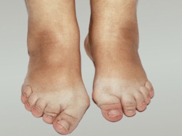 Osteoarthritis of the foot with severe deformation of the toes