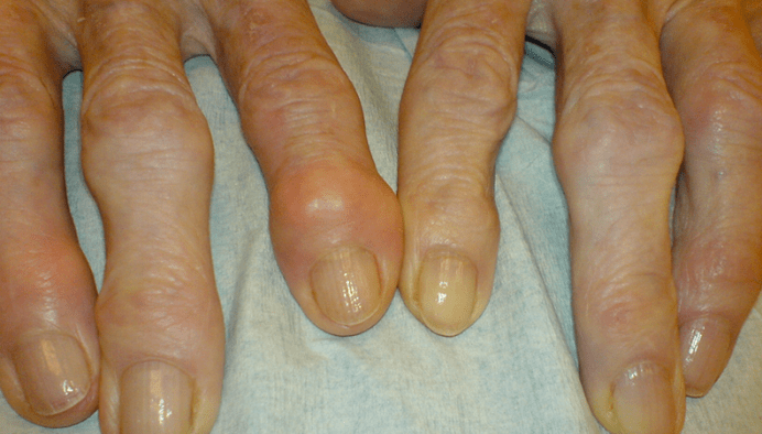 Pain in the finger joints with osteoarthritis