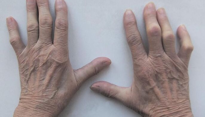 Pain in the finger joints