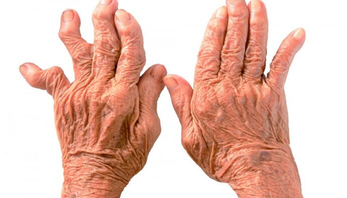 Rheumatoid arthritis as a cause of pain in the finger joints