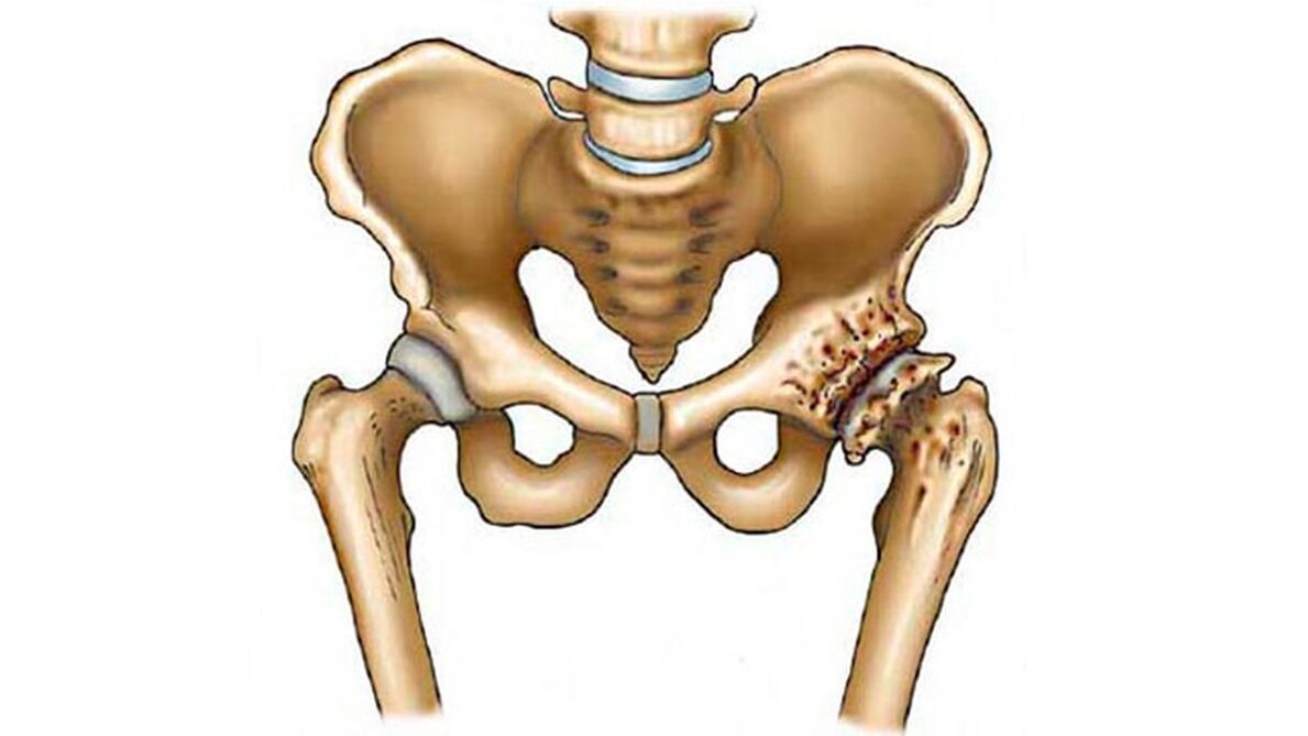 damage to the hip joint with the presence of arthrosis