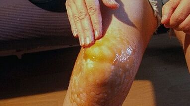 Rubbing for the treatment of knee joint arthrosis