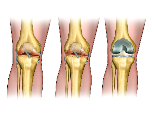 the articular cartilage