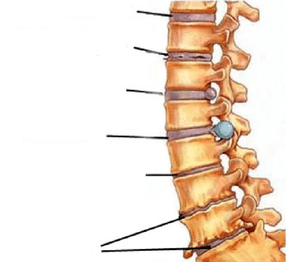 stage of development of spinal osteochondrosis