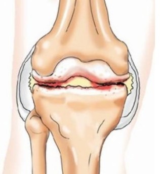 Vospaleniya ligaments of the knee