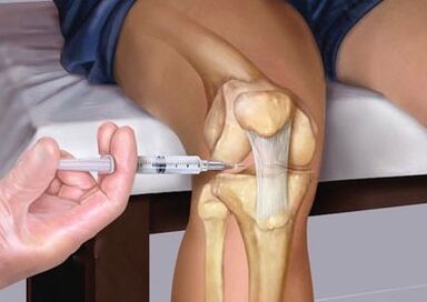 An injection at the joint