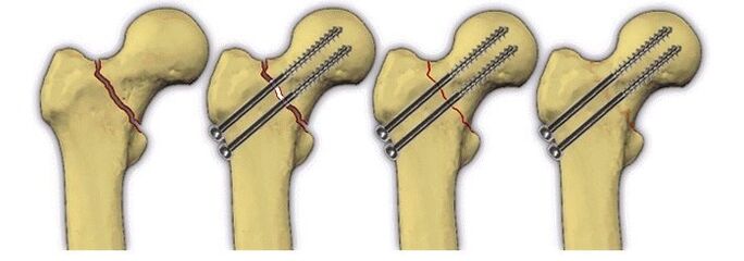 fixation of the bone body with a pin for pain in the hip joint