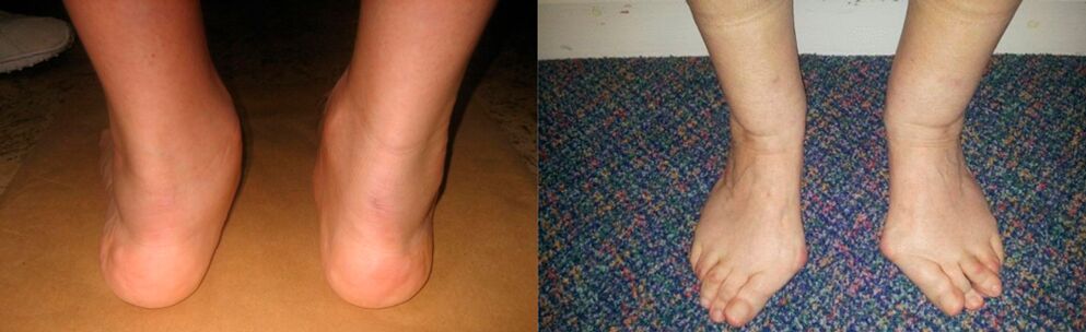 Arthrosis of the big toe and deformed arthrosis of the ankle