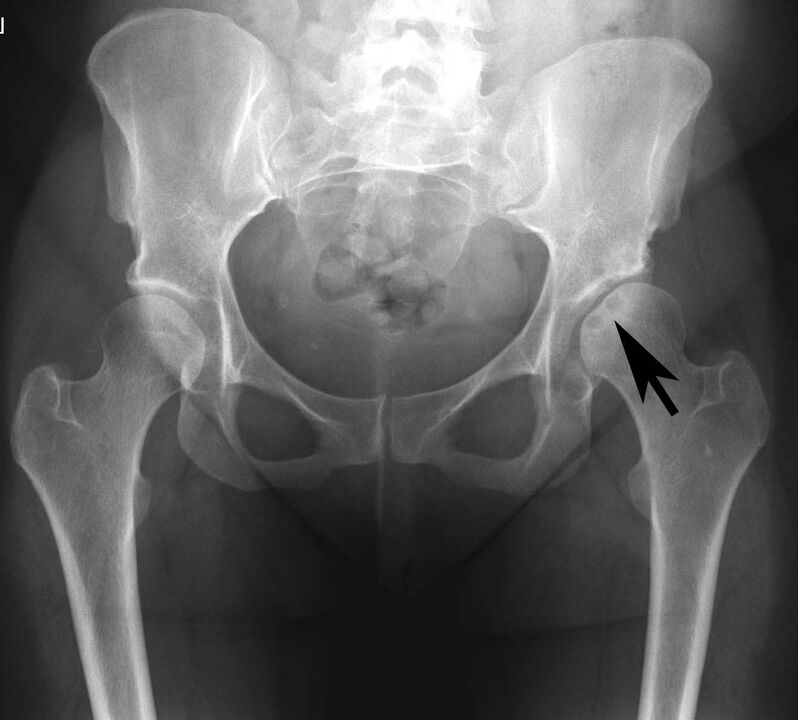 Calcium salt deposition in the hip joint with pseudogout on x-ray