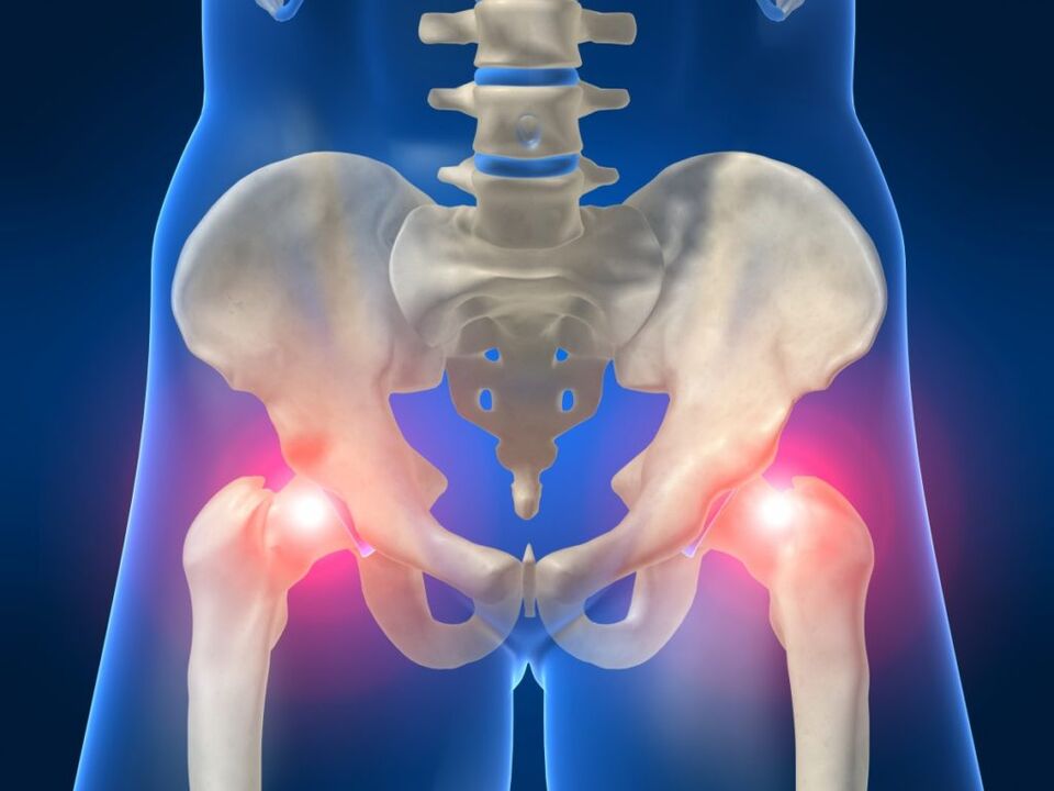 In ankylosing spondylitis, bilateral pain in the hip joint interferes