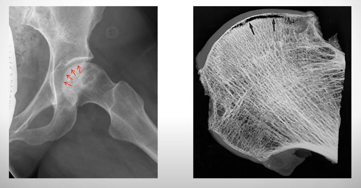 X-ray of the femoral head is affected by aseptic necrosis